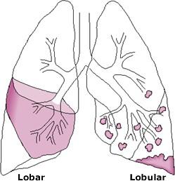 Lobární a lobulární pneumonie