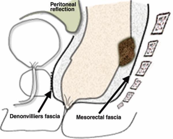 Mezorektální fascie Viscerální vrstva endopelvické fascie Obsahuje rectum, tuk, uzliny, lymfatika, cévy Dorsálně splývá s presakrální fascií Ventrálně u mužů splývá s pojivovou tkání kryjící semenné