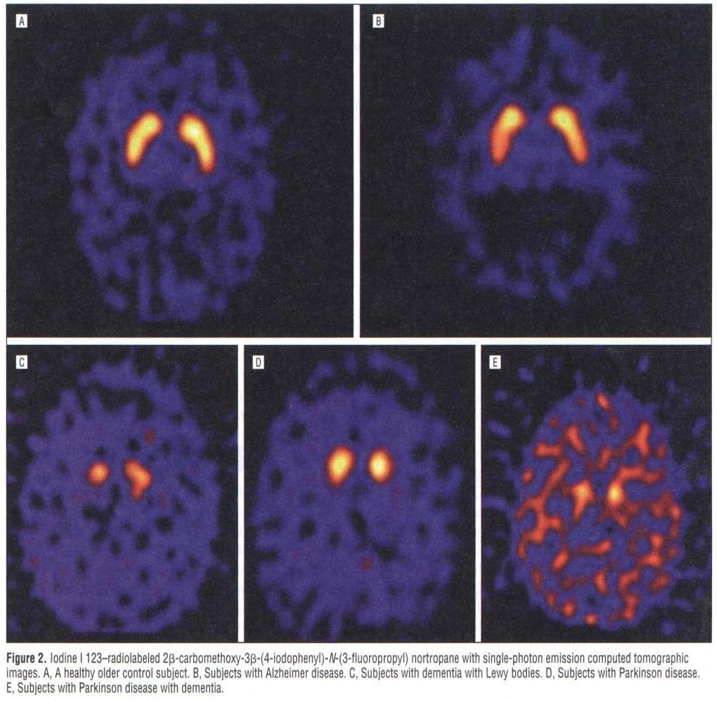 FP-CIT SPECT: DLB vs.