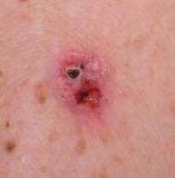 Lidské Beta papillomaviry (kožní) Nemelanomový karcinom kůže (NMSC): bazocelulární a spinocelulární karcinom HPV 5 a HPV 8 Pacienti s epidermodysplasia verruciformis mutace EVER1/2 Pacienti po