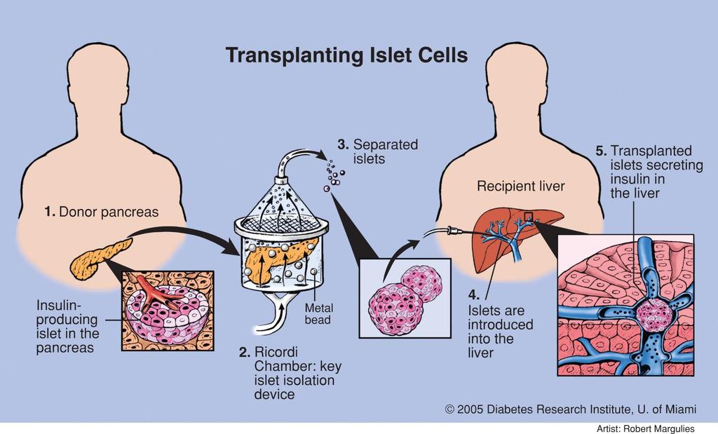 Transplantace