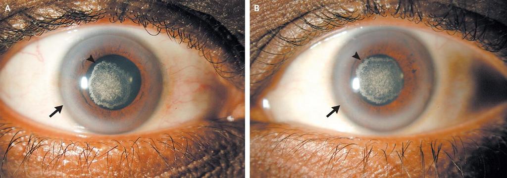 Arcus lipoides corneae Slit-lamp examination revealed a central collection of anterior stromal crystalline deposits (arrowheads) and arcus lipoides (arrows) in the cornea.