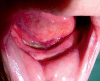 Definice osteonekrózy pfii léãbû bisfosfonáty (Bisphosphonate-Related Osteo- Necrosis of the Jaw, BRONJ) je stanovena AAOMS (American Association of Oral and Maxillofacial Surgeons) jako nekrotická