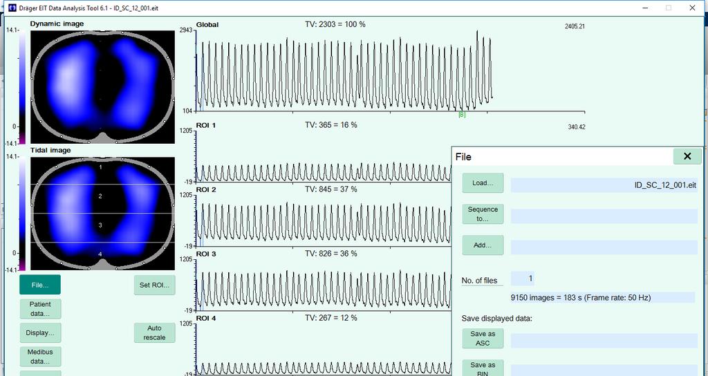2.2 Způsob zpracování dat Data naměřená pomocí přístroje PulmoVista 500 jsou ukládána ve formátu *.eit a k jejich zpracování a vyhodnocení je využíván software Dräeger EIT Data Analysis Tool 6.