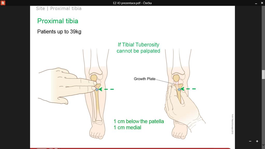 Proximální tibie Děti < 39 kg Vyhmatat tuberositas tibie + 1 cm