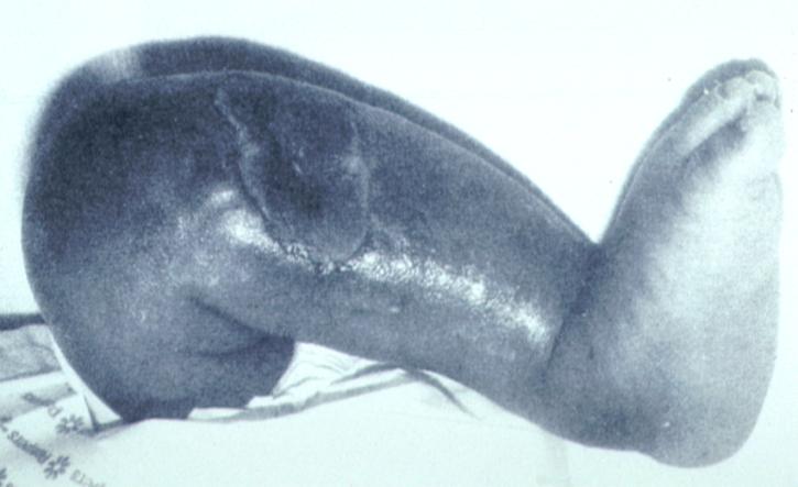 Komplikace Závažné komplikace IO: osteomyelitis, fraktura, infekce, extravazace, kompartment syndrom a poranění růstové ploténky Studie: Dospělí (2004-2009) < 0,004% Děti osteomyelitis < 0, 6% (4200