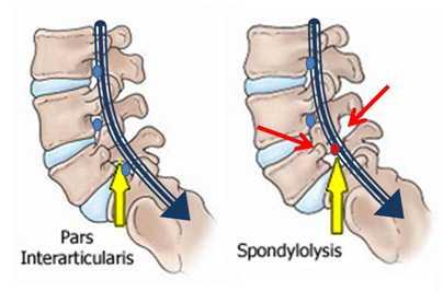 Traumatická spondylolistéza L5-S1 pars interarticularis Přední ventrální posun