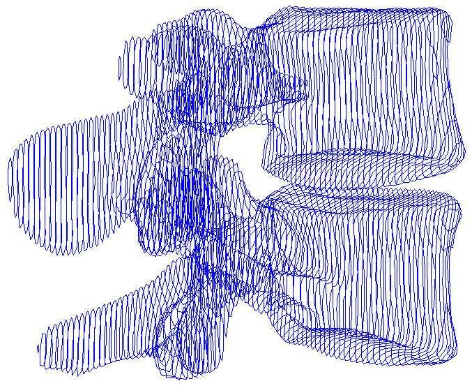 TVORBA MODELU Na základě CT řezů (viz. obr. 1), které poskytl doc. MUDr. Petr Krupa, CSc. z Fakultní nemocnice U svaté Anny v Brně, byl pomocí programu Ansys vytvořen model geometrie.