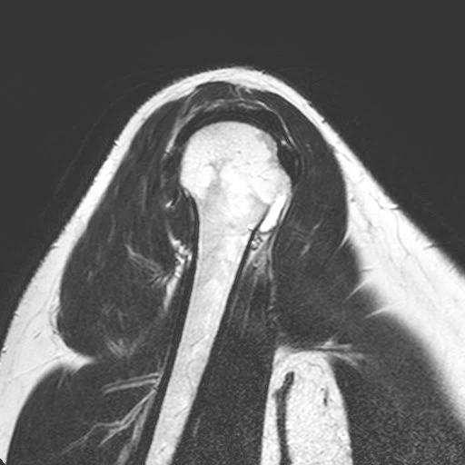 ruptura norma T1 m.supraspinatus m.