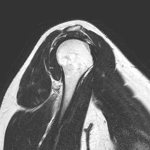 ruptura norma T1 m.supraspinatus m.