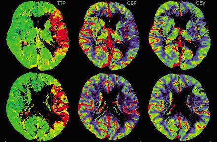 Penumbra na perfuzním CT prodloužené MTT/TTP a: normální CBF a