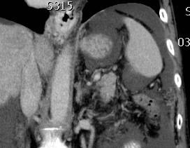 Supramezokolický prostor Mezi bránicí a mesocolon transversum: intraperitoneální oddíly vpravo: subfrenický (suprahepatický)