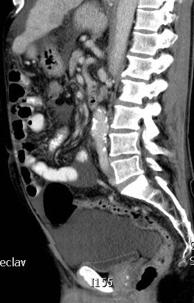 Peritoneum v pánvi u muže: excavatio rectovesicalis u ženy: