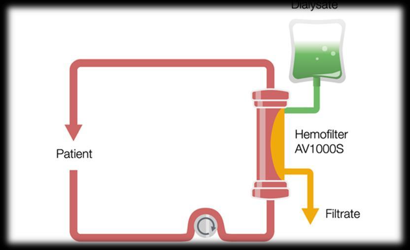 CVVHD = kontinuální veno-venózní hemodialýza (continuous veno-venous hemodialysis) pro transport solutů se využívá filtrace i difúze při této metodě neaplikujeme substituční roztok, ale naopak