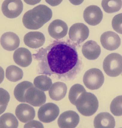 Interpretace A. Chronická lymfatická leukemie B CLL B. Hairy cell leukemie HCL C.