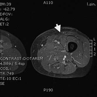 Obr. 4. MRI T1 s kontrastem obraz levého stehna bez přítomnosti nádorové tkáně po radikální resekci následované radioterapií a brachyterapií.
