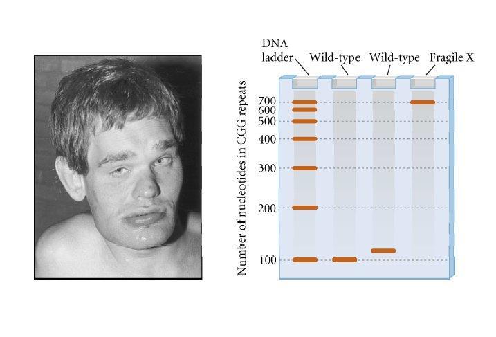 PCR-produkty Syndrom fragilního chromozomu X (Martin-Bell): gen FMR1 kóduje RNA-vazebný protein, který je