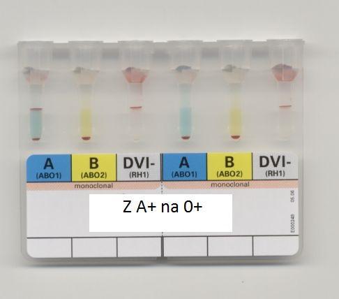 krevní skupiny. Na druhou stranu, pakliže jsou stále přítomny ve větší míře původní antigeny, je velká pravděpodobnost relapsu onemocnění a/nebo selhání štěpu.