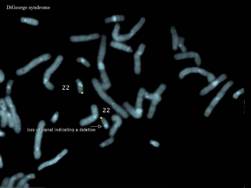 chromozomu (úsek 22q11) omezený vývoj (až úplná absence) brzlíku, příštitných tělísek,