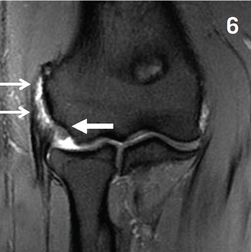 Příloha č. 2 : Laterární epikondylitida na MRI snímku Zdroj: MRI of the athlete with elbow pain.