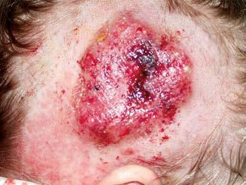 Obr. 1. Tinea kštice také houbami, nejsou však jimi vyvolané (např. dermatitis seborhoica).