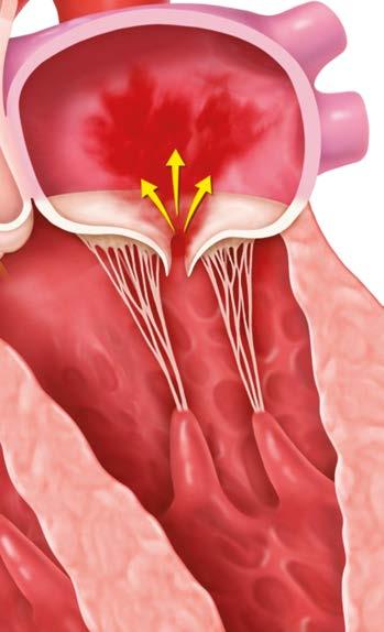 Tab.. Srovnání základní charakteristiky u studie EVEREST II a velkých registrů EVEREST II (n = 8) ACESS-EU (n = 567) Transcatheter Valve Treatment Sentinel Pilot Registry (n = 68) TRAMI (n = 79) Věk