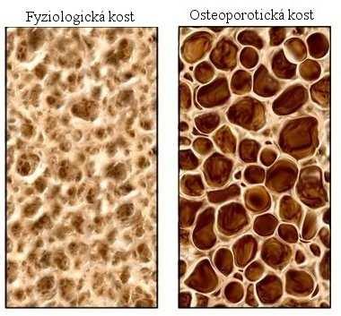 1 Definice a klasifikace osteoporózy Zmínky o osteoporóze můžeme nalézt již na starých čínských a řeckých malbách, kde byly znázorněny ženy s typickým tvarem osteoporotické hrudní kyfózy.