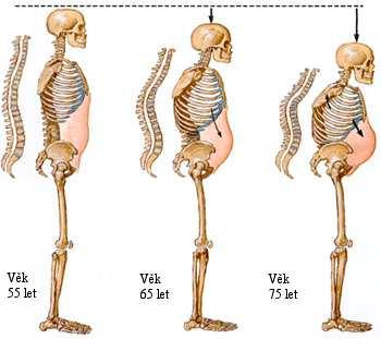 5 Klinický obraz osteoporózy OP patří mezi onemocnění, která mohou probíhat zcela asymptomaticky. Mohou se ale objevovat bolesti zad, či beder.