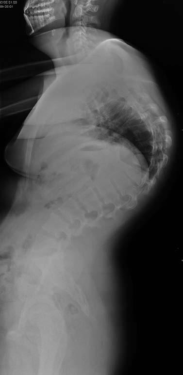 rokem) V tomto stadiu se již projevují první změny na RTG snímcích a začíná tuhnutí deformity. 3. stadium následků (po 18.