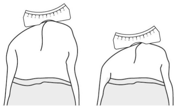 Obrázek 2 Adamsův test předklonu (Zdroj:https://www.google.cz/search?espv=2&biw=1366&bih=613&tbm=isch&sa=1&q=ada ms+test+&oq=adams+test+&gs_l=img.3..0i19k1l2j0i30i19k1j0i8i30i19k1l5.75622.76753.0.7 8261.