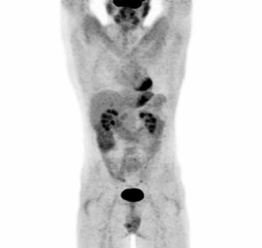 Ces Radiol 20; 72(1): 46 50 Obr. 1. F-FDG PET/CT, PET 3D rekonstrukce za 60 minut po i.v. aplikaci radiofarmaka.