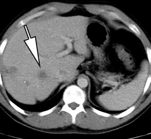 No pathological F-FDG uptake was observed in the liver or in the body. Obr. 2. F-FDG PET/CT, CT transverzální řez za 60 minut po i.v. aplikaci radiofarmaka.