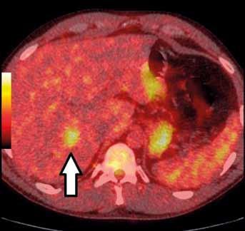 The increased focal F-FDG uptake was demonstrated in the right liver lobe (arrowhead). Obr. 5. F-FDG PET/CT, PET/CT fúze, transverzální řez za 0 minut po i.v. aplikaci radiofarmaka.