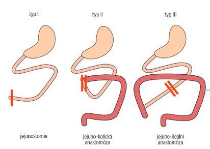 Klasifikace syndromu krátkého střeva Typ I Jejunostomie (či vysoká ileostomie) Typ II Jejunokolická