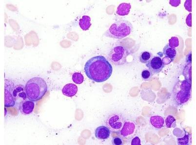 Retikulocyt Je bezjaderný krevní element, jde o tzv. mladý erytrocyt. Velikost této buňky je 7-9 µm. U retikulocytu zůstávají v cytoplazmě zbytky některých organel např.