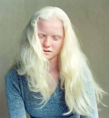 Albinismus Většinou AR Okulokutánní