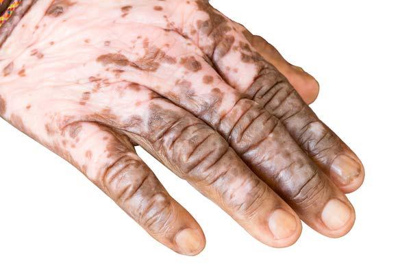 Vitiligo Postnatálně vznikající Skvrnitá depigmentace kůže a chlupů / vlasů Etiologie