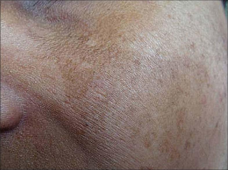 Sekundární (exogenní) ochronóza dermatitis způsobená topickou aplikací