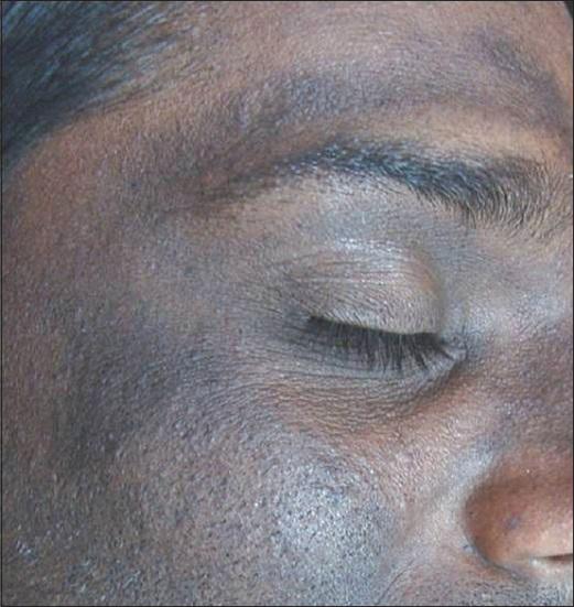 pacientů používajících vybělující krémy - erytém, mírná hyperpigmentace -