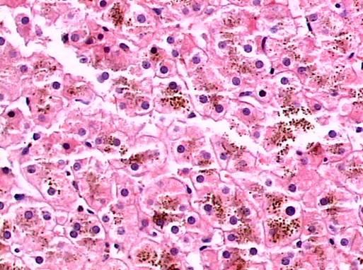v místech vstřebávání tuků, starší hematomy (hemofuscin) Lysosomální