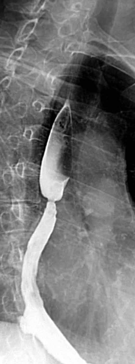 Obr. 2A Obr. 2B Obr. 2C Obr. 2. Šedesátičtyřletá žena s benigní pooperační strikturou jícnu rezistentní na balonkovou dilataci.