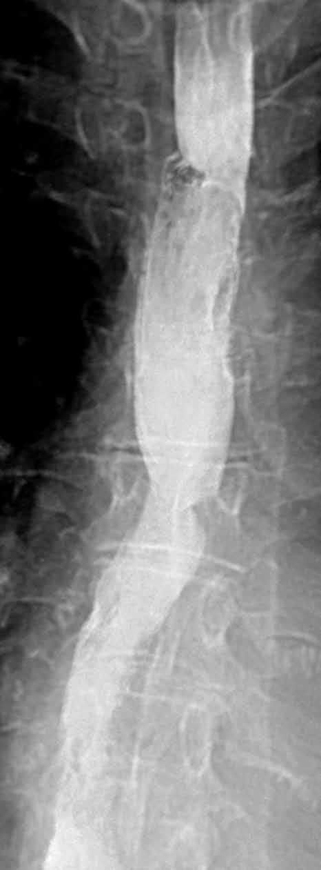 Stent je již rozložený, pasáž oblastí anastomózy je volná. Fig. 2. 64-year old woman with benign postoperative oesophageal stricture resistent for balloon dilatation.