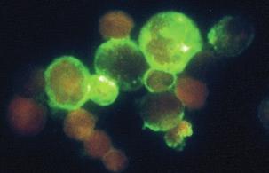 INFEKČNÍ SEROLOGIE Herpetické viry Varicella zoster virus - VZV ELISA-VIDITEST a IF-VIDITEST anti-vzv soupravy se používají pro diagnostiku chorob vyvolaných nebo souvisejících s VZV, jako jsou plané