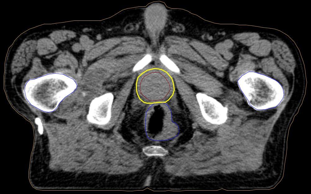 Obrázek 1: Plánování radioterapie, zakreslení