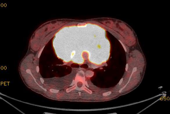 Patient KH 1950- dg DLBC DLBCL - 62 y old - CS IIB - Bulky