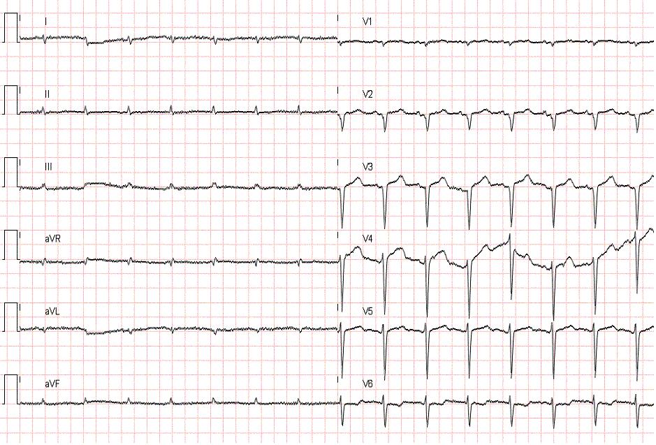 EKG