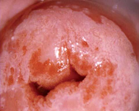 děložním čípku po vaginálním porodu (ektropie, ektropium). Opačná situace, tzn. vtažení (inverze) skvamokolumnární junkce do endocervixu (obr.