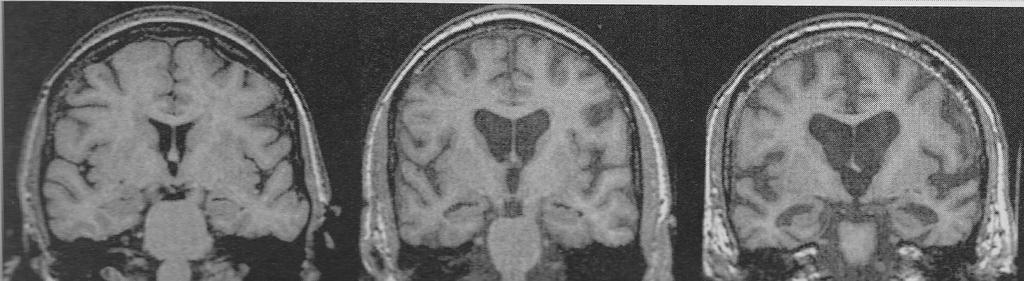 MRI mozku longitudinální sledování Norma