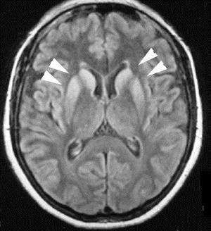 MRI Změny signálu v