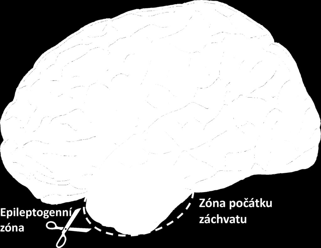 Symbol nůžek u epileptogenní zóny značí nutnost odstranění této oblasti pro úplné vymizení záchvatů. 1.